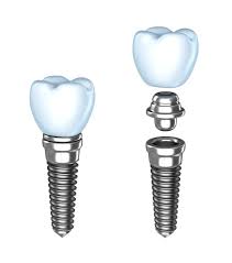 dental implants constructure