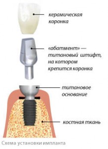 implantation shema implant